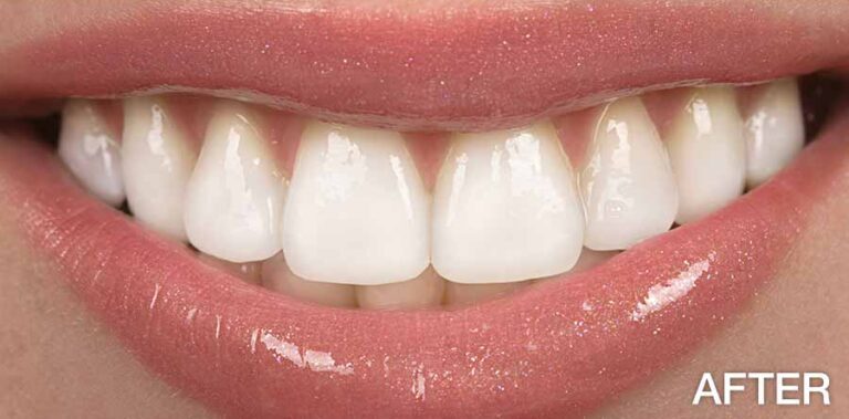 before-after-teeth-whitening