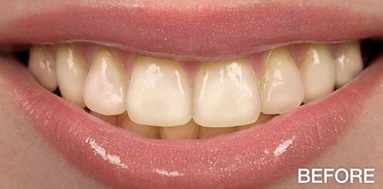 before-after-teeth-whitening